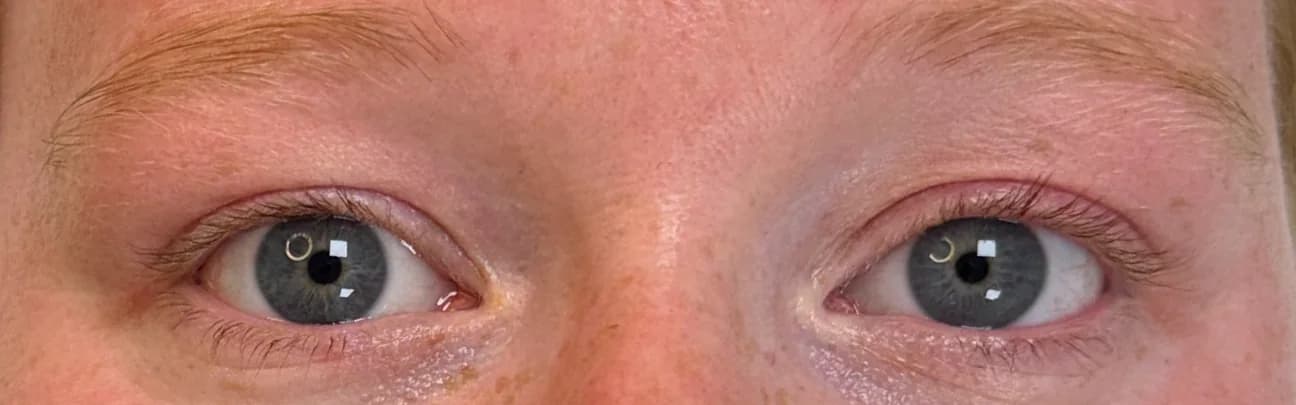 Beide ogen voor de behandeling, met lichte wenkbrauwen en rechte wimpers