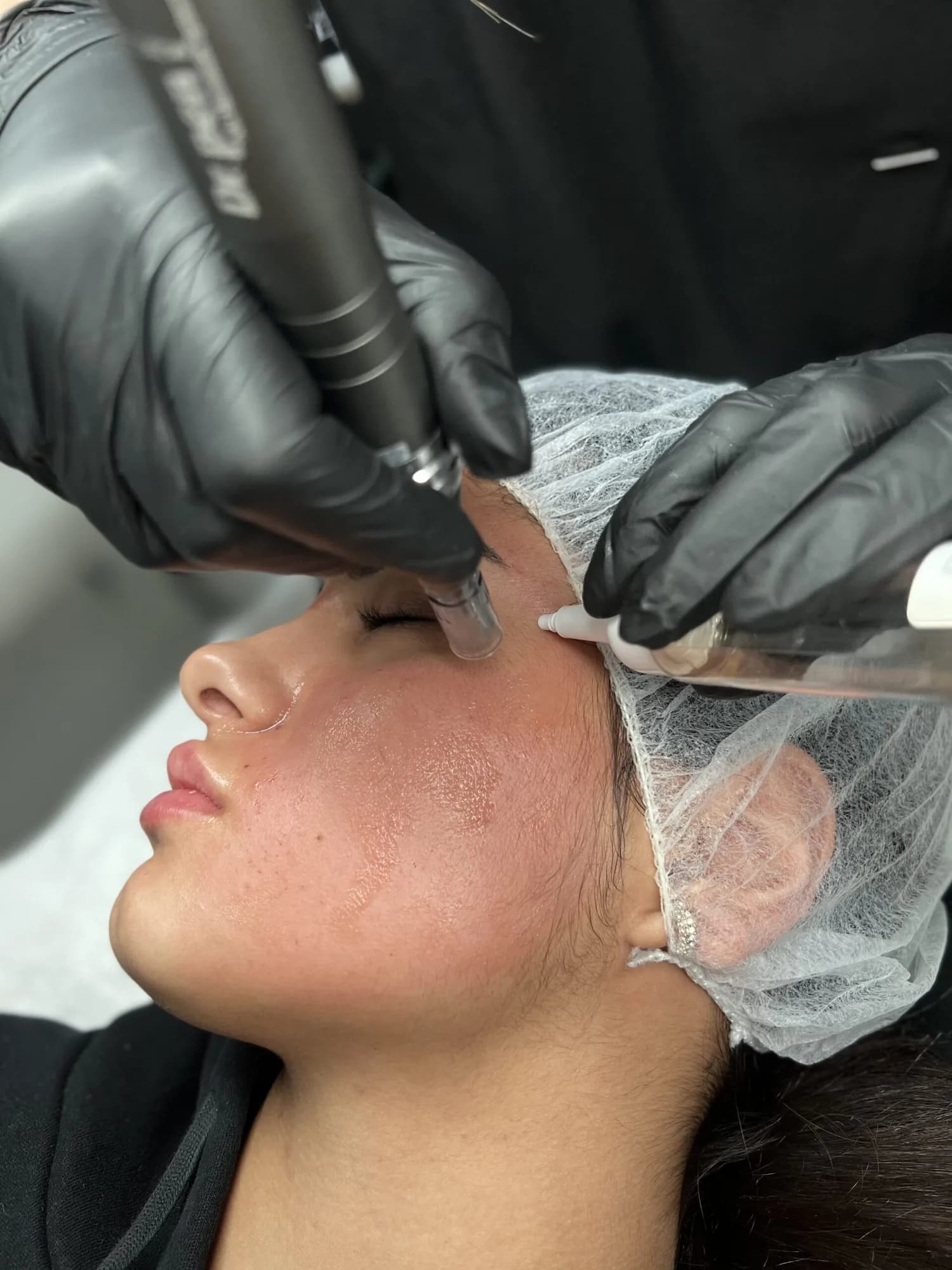 Microneedling-behandeling met de Dermapen 4 bij Moons Beauty