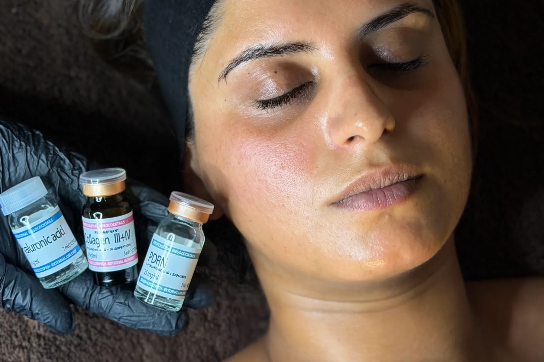 Drie flesjes serum naast het gezicht van een klant: hyaluronzuur, collageen en PDRN