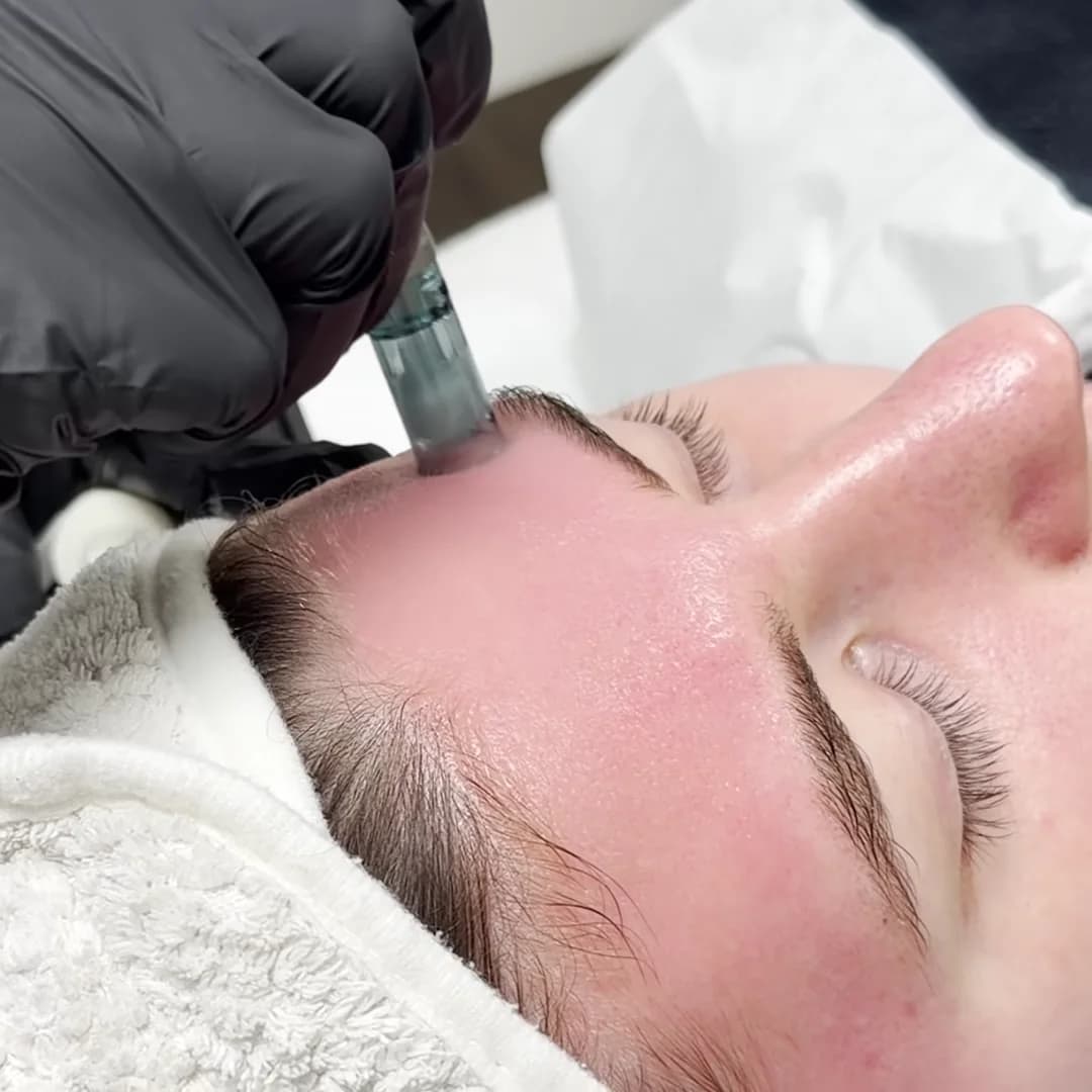 Een microneedling-pen op het voorhoofd van een klant met een haarband om