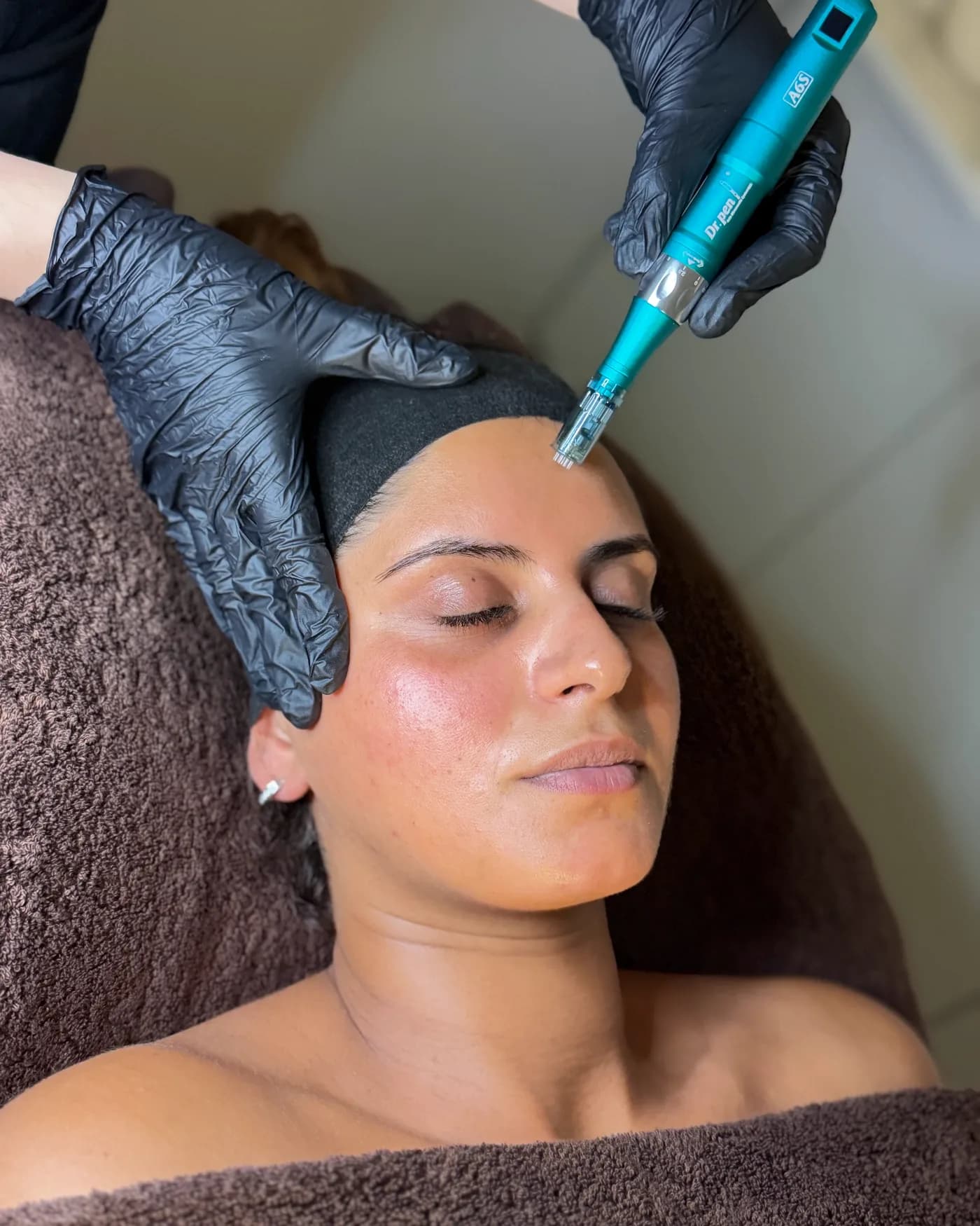 Microneedling mit dem Dermapen auf der Stirn